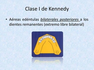 Clase I de Kennedy
• Aéreas edéntulas bilaterales posteriores a los
dientes remanentes (extremo libre bilateral)
 