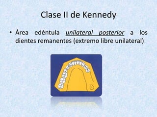 Clase II de Kennedy
• Área edéntula unilateral posterior a los
dientes remanentes (extremo libre unilateral)
 