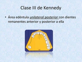 Clase III de Kennedy
• Área edéntula unilateral posterior con dientes
remanentes anterior y posterior a ella
 