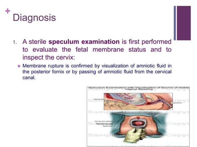 Preterm Prom Preterm Premature Rupture Of Membranes (PPROM) | PPTX