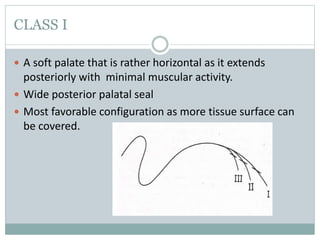 CLASS I
 A soft palate that is rather horizontal as it extends
posteriorly with minimal muscular activity.
 Wide posterior palatal seal
 Most favorable configuration as more tissue surface can
be covered.
 