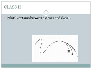CLASS II
 Palatal contours between a class I and class II
 