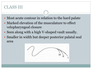 CLASS III
 Most acute contour in relation to the hard palate
 Marked elevation of the musculature to effect
velopharyngeal closure
 Seen along with a high V-shaped vault usually.
 Smaller in width but deeper posterior palatal seal
area
 