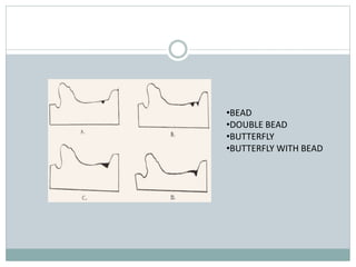 •BEAD
•DOUBLE BEAD
•BUTTERFLY
•BUTTERFLY WITH BEAD
 