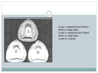 CLASS I- MODIFIED BUTTERFLY
APPR 3-4 MM WIDE
CLASS II- MODIFIED BUTTERFLY
APPR 2-3 MM WIDE
CLASS III- A BEAD
 