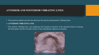 ANTERIOR AND POSTERIOR VIBRATING LINES
• The posterior palatal seal area lies between the anterior and posterior vibrating lines.
 ANTERIOR VIBRATING LINE
• The anterior vibrating line is an imaginary line located at junction of the attached tissues overlying
the hard palate and the movable tissues of the immediately adjacent soft palate.
 