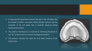 It represents the demarcation between that part of the soft palate that
has limited or shallow movement during function (quivers) and the
remainder of the soft palate that is markedly displaced during
functional movements.
 The posterior vibrating line is visualized by instructing the patient to
say “ah” in short bursts in a normal, unexaggerated fashion.
 The posterior vibrating line marks the most distal extension of the
denture base.
 