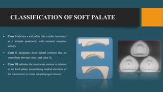 CLASSIFICATION OF SOFT PALATE
 Class I indicates a soft palate that is rather horizontal
as it extends posteriorly, with minimal muscular
activity.
 Class II designates those palatal contours that lie
somewhere between class I and class III.
 Class III indicates the most acute contour in relation
to the hard palate, necessitating marked elevation of
the musculature to create velopharyngeal closure.
 