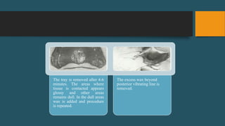 The tray is removed after 4-6
minutes. The areas where
tissue is contacted appears
glossy and other areas
remains dull. In the dull areas
wax is added and procedure
is repeated.
The excess wax beyond
posterior vibrating line is
removed.
 