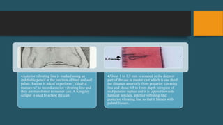 Anterior vibrating line is marked using an
indeliable pencil at the junction of hard and soft
palate. Patient is asked to perform “Valsalva
manuevre” to record anterior vibrating line and
they are transferred to master cast. A Kingsley
scraper is used to scrape the cast.
About 1 to 1.5 mm is scraped in the deepest
part of the see in master cast which is one third
the distance anteriorly from posterior vibrating
line and about 0.5 to 1mm depth in region of
mid palatine raphae and it is tapered towards
hamular notches, anterior vibrating line,
posterior vibrating line so that it blends with
palatal tissues.
 