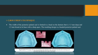2.BOUCHER’S TECHNIQUE
 The width of the posterior palatal seal is limited to a bead on the denture that is 1.5 mm deep and
1.5 mm broad at its base with a sharp apex. The resulting design is a beaded posterior palatal seal.
 