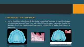 3.BERNARD LEVIN’S TECHNIQUE
 It is for class III soft palate forms: He described a, “double bead” technique for class III soft palate.
In this technique, a depth of about 1mm and width of 1.5mm is scraped in posterior vibrating line.
A distance 3 to 4 mm from posterior border, anterior vibrating line is beaded. This is known as
rescue bead.
 