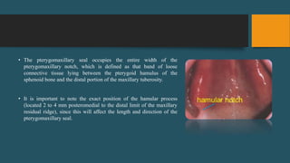 • The pterygomaxillary seal occupies the entire width of the
pterygomaxillary notch, which is defined as that band of loose
connective tissue lying between the pterygoid hamulus of the
sphenoid bone and the distal portion of the maxillary tuberosity.
• It is important to note the exact position of the hamular process
(located 2 to 4 mm posteromedial to the distal limit of the maxillary
residual ridge), since this will affect the length and direction of the
pterygomaxillary seal.
 