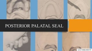 POSTERIOR PALATAL SEAL
AJAY YERRAMSETTI
 