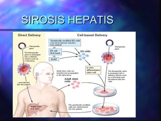 SIROSIS HEPATIS
 