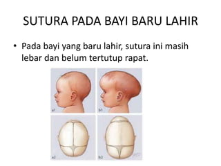 SUTURA PADA BAYI BARU LAHIR
• Pada bayi yang baru lahir, sutura ini masih
lebar dan belum tertutup rapat.

 