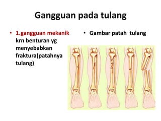 Gangguan pada tulang
• 1.gangguan mekanik
krn benturan yg
menyebabkan
fraktura(patahnya
tulang)

• Gambar patah tulang

 
