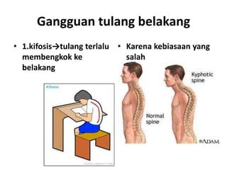 Gangguan tulang belakang
• 1.kifosis→tulang terlalu • Karena kebiasaan yang
membengkok ke
salah
belakang

 