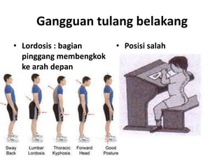 Gangguan tulang belakang
• Lordosis : bagian
pinggang membengkok
ke arah depan

• Posisi salah

 