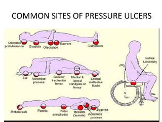 COMMON SITES OF PRESSURE ULCERS
 