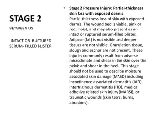 STAGE 2
• Stage 2 Pressure Injury: Partial-thickness
skin loss with exposed dermis
Partial-thickness loss of skin with exposed
dermis. The wound bed is viable, pink or
red, moist, and may also present as an
intact or ruptured serum-filled blister.
Adipose (fat) is not visible and deeper
tissues are not visible. Granulation tissue,
slough and eschar are not present. These
injuries commonly result from adverse
microclimate and shear in the skin over the
pelvis and shear in the heel. This stage
should not be used to describe moisture
associated skin damage (MASD) including
incontinence associated dermatitis (IAD),
intertriginous dermatitis (ITD), medical
adhesive related skin injury (MARSI), or
traumatic wounds (skin tears, burns,
abrasions).
BETWEEN US
-INTACT OR RUPTURED
SERUM- FILLED BLISTER
 
