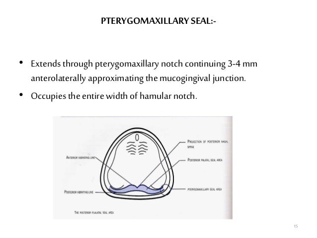posterior palatal seal