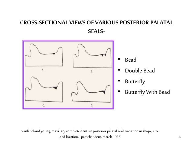 posterior palatal seal