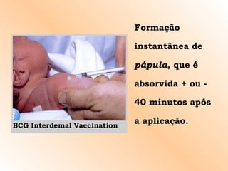 Formação instantânea de  pápula , que é absorvida + ou - 40 minutos após a aplicação. 