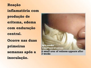 Reação inflamatória com produção de eritema, edema com enduração central. Ocorre nas duas primeiras semanas após a inoculação. 