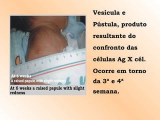Vesícula e Pústula, produto resultante do confronto das células Ag X cél. Ocorre em torno da 3ª e 4ª semana. 