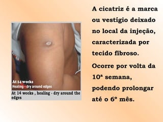 A cicatriz é a marca ou vestígio deixado no local da injeção, caracterizada por tecido fibroso. Ocorre por volta da 10ª semana, podendo prolongar até o 6º mês. 