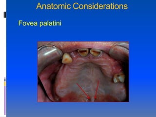 Anatomic Considerations
Fovea palatini
 
