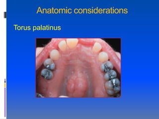 Anatomic considerations
Torus palatinus
 