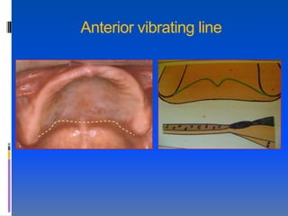 Anterior vibrating line
 
