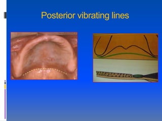 Posterior vibrating lines
 
