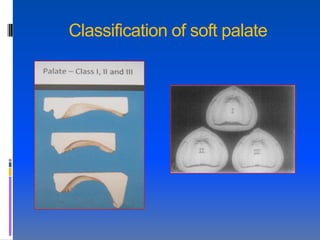 Classification of soft palate
 