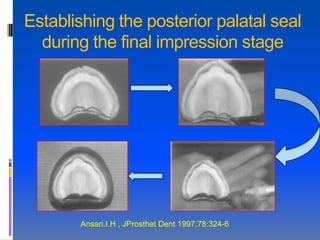 Establishing the posterior palatal seal
  during the final impression stage




       Ansari.I.H , JProsthet Dent 1997;78:324-6.
 