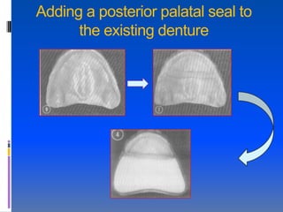 Adding a posterior palatal seal to
      the existing denture
 