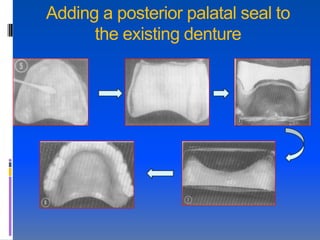 Adding a posterior palatal seal to
      the existing denture
 