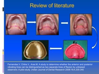 Review of literature




Fernendes.V, Chitre.V., Aras.M, A study to determine whether the anterior and posterior
vibrating lines can be distinguished as two separate lines of flexion by unbiased
observers: A pilot study ,Indian Journal of Dental Research 2008:19;4,335-340
 