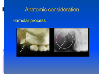 Anatomic consideration
Hamular process
 