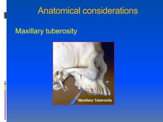 Anatomical considerations

Maxillary tuberosity
 