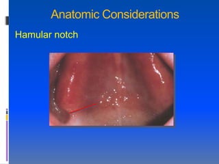 Anatomic Considerations
Hamular notch
 