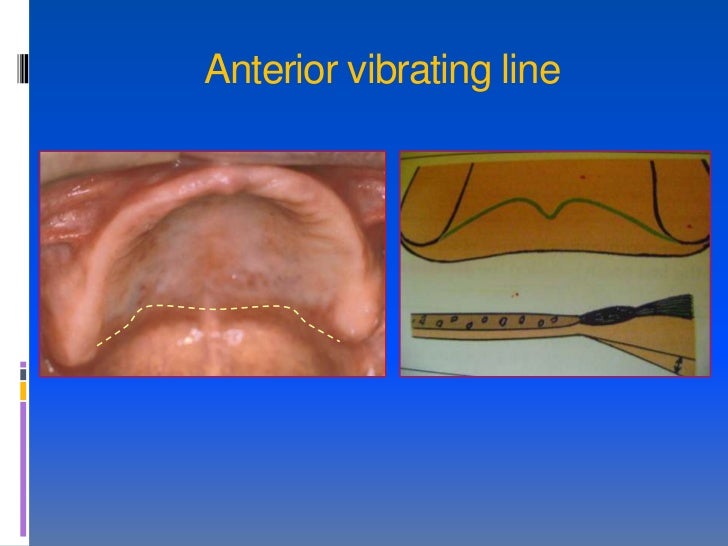 posterior palatal seal ppt hamular notch