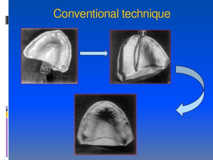 posterior palatal seal