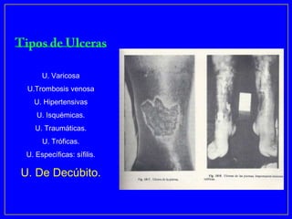 U. Varicosa
 U.Trombosis venosa
   U. Hipertensivas
    U. Isquémicas.
    U. Traumáticas.
      U. Tróficas.
 U. Específicas: sífilis.

U. De Decúbito.
 