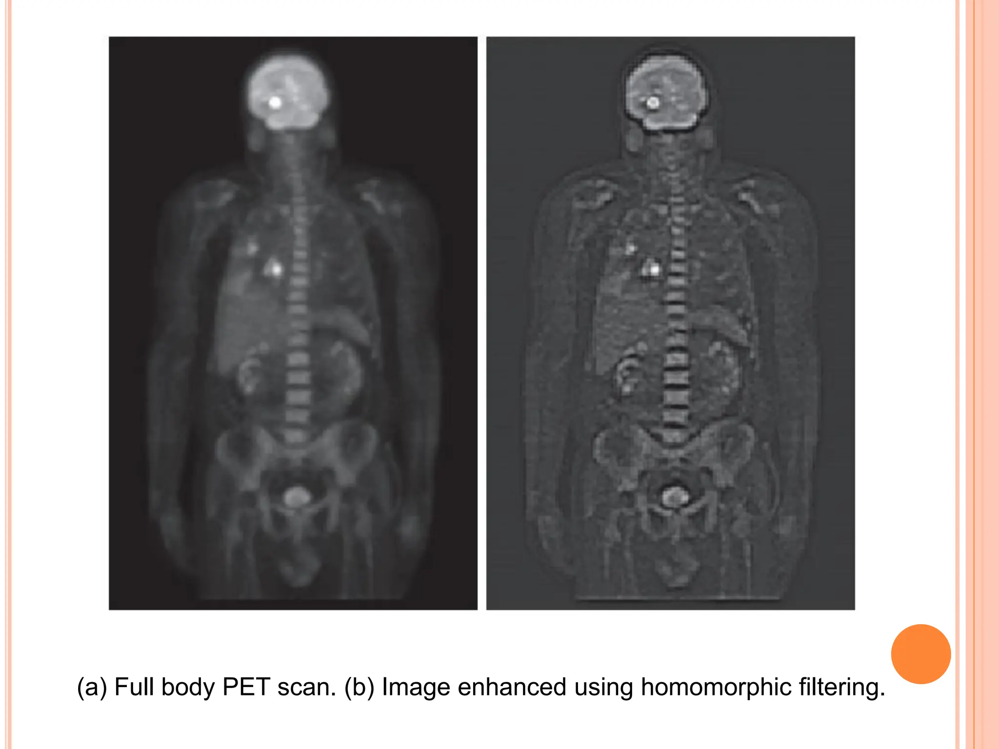 (a) Full body PET scan. (b) Image enhanced using homomorphic filtering.
 