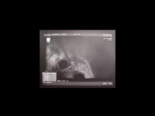 Эхографическое исследование
(УЗИ)
 