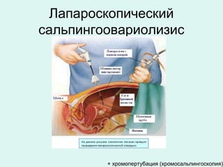 Лапароскопический
сальпингоовариолизис
+ хромопертубация (хромосальпингоскопия)
 
