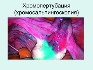 Хромопертубация
(хромосальпингоскопия)
 